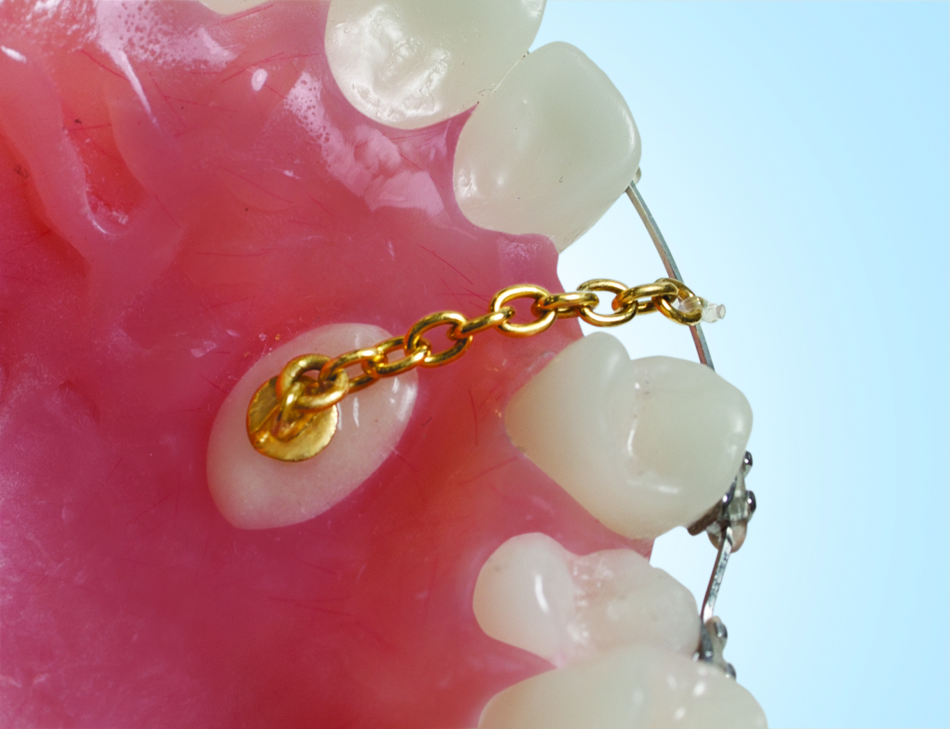 Eruption Appliance (3878)